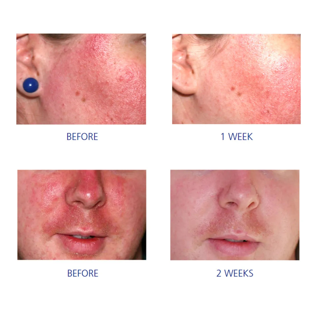 Before and after skin treatment results showing improvement over two weeks.