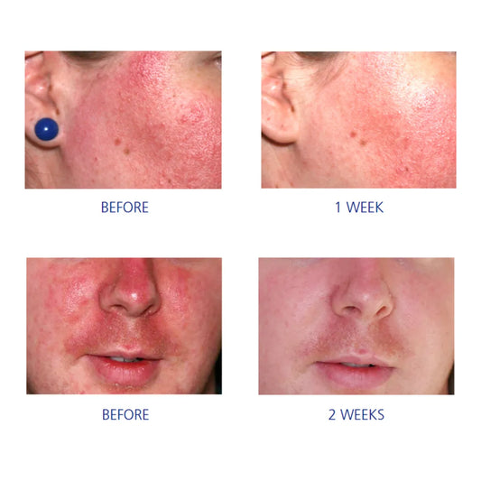 Before and after skin treatment results showing improvement over two weeks.